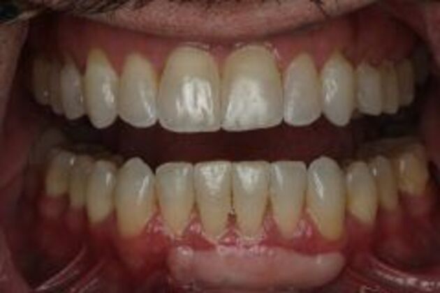 Invisalign Case 8 - After