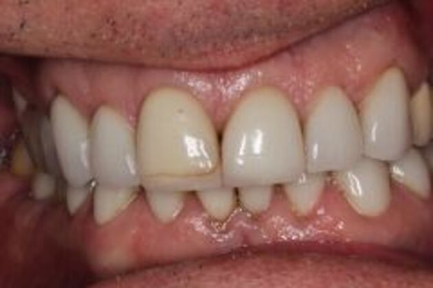 New Smile Case 1 - Before