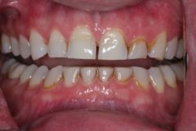 New Smile Case 2 - Before