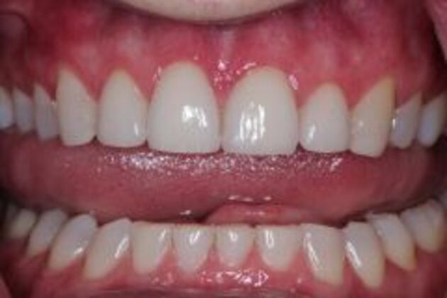 New Smile Case 2 - After