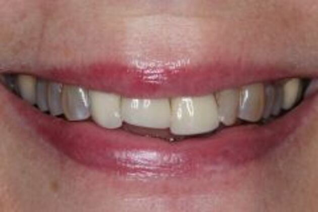 New Smile Case 3 - Before