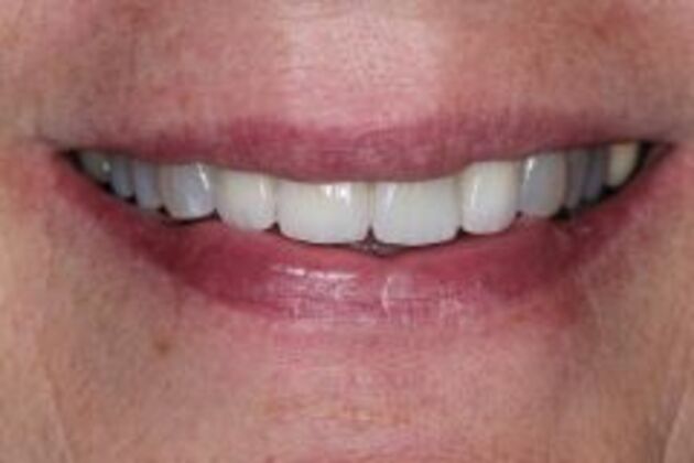 New Smile Case 3 - After