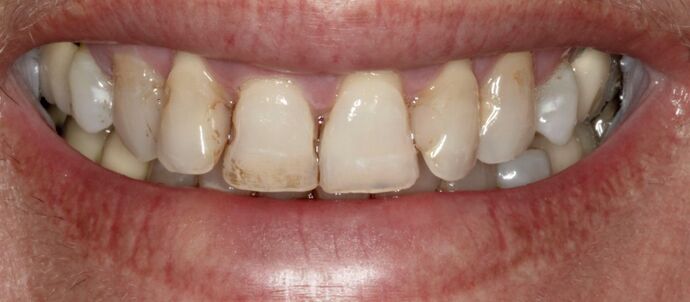 Smile Makeover & Veneers: Sarah - Before