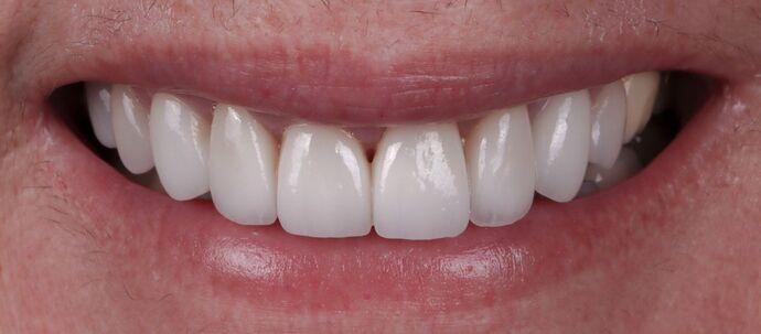 Smile Makeover & Veneers: Sarah - After