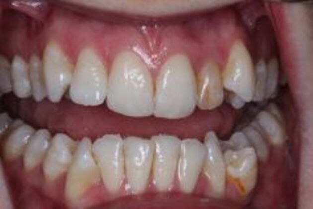 Single Tooth Replacement Case 1 - Before