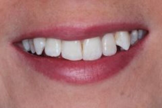 Single Tooth Replacement Cases