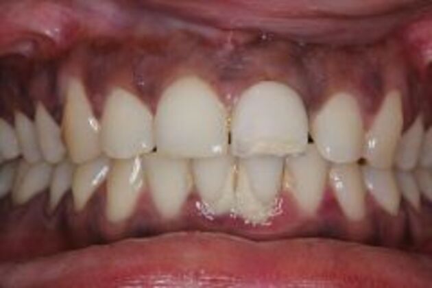 Single Tooth Replacement Case 2 - Before