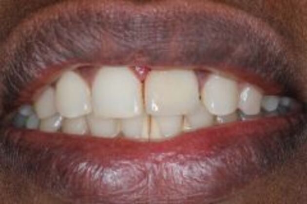 Single Tooth Replacement Case 2 - After