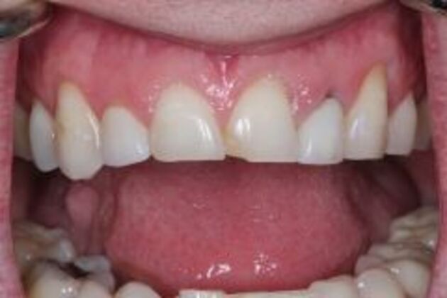 Single Tooth Replacement Case 3 - Before