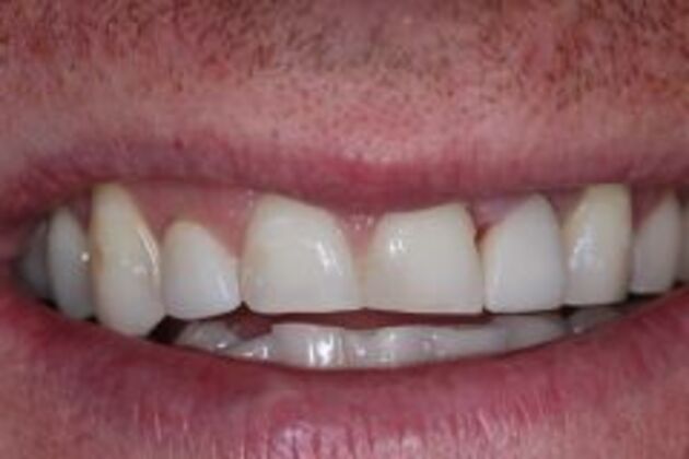 Single Tooth Replacement Case 3 - After