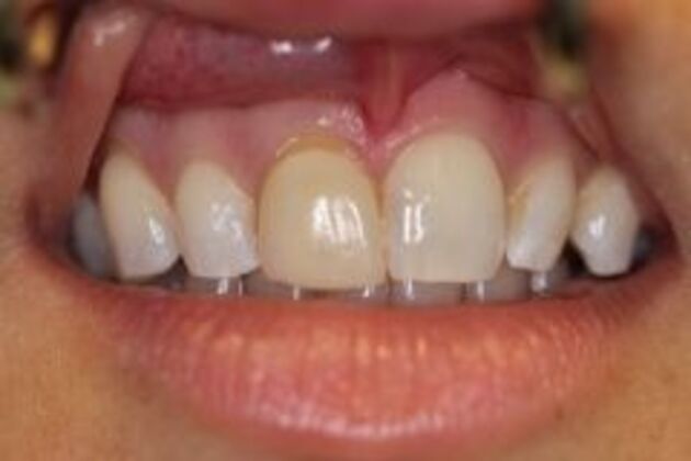 Single Tooth Replacement Case 4 - Before