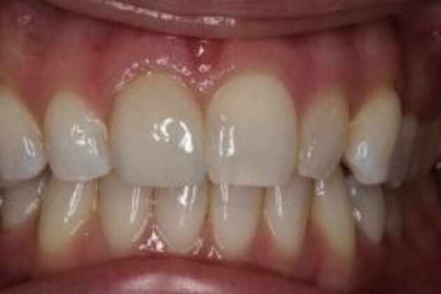 Single Tooth Replacement Case 4 - After
