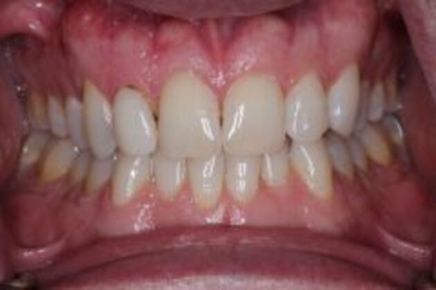 Single Tooth Replacement Case 5 - Before