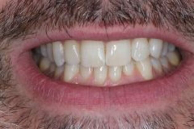 Single Tooth Replacement Case 5 - After