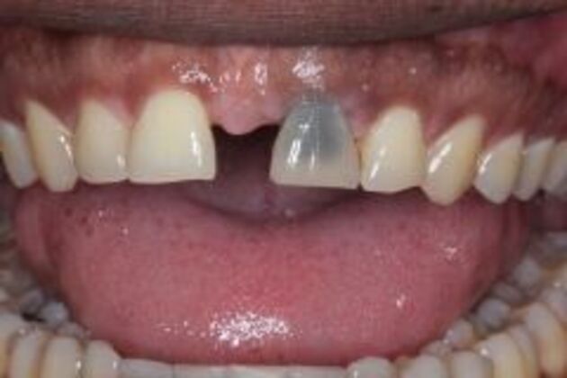 Single Tooth Replacement Case 6 - Before