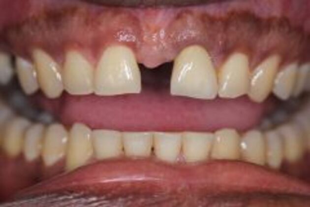 Single Tooth Replacement Case 6 - After