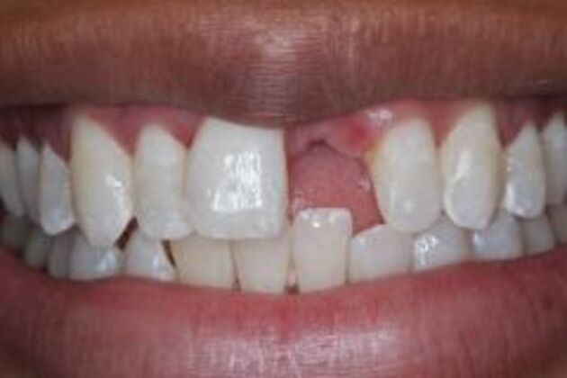 Single Tooth Replacement Case 7 - Before