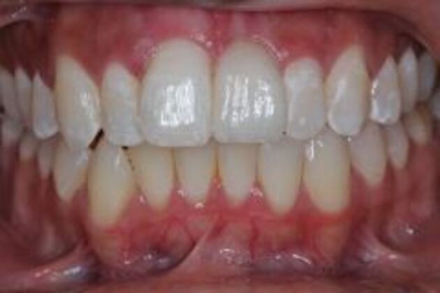 Single Tooth Replacement Case 7 - After