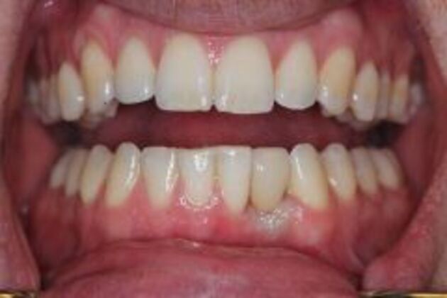Dental Implants Cases