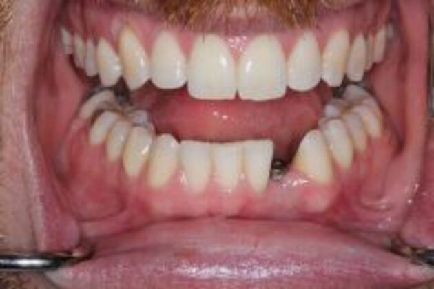 Dental Implants Case 1 - Before