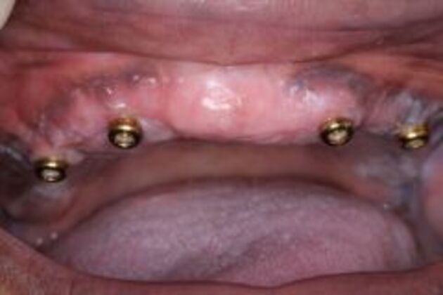 Dental Implants Case 2 - Before