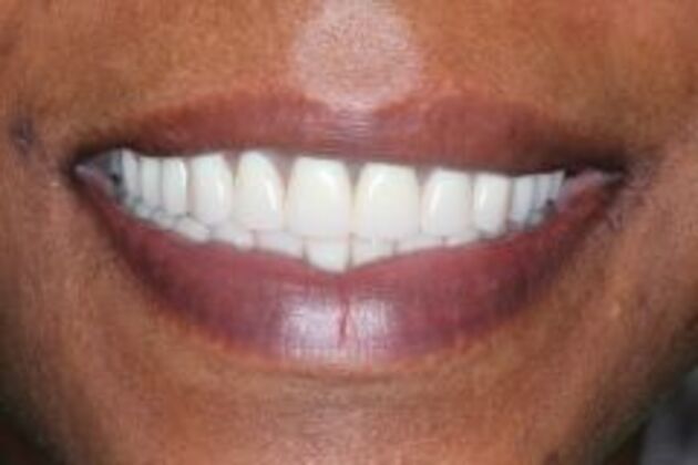 Dental Implants Case 2 - After