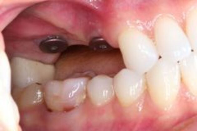 Dental Implants Case 3 - Before