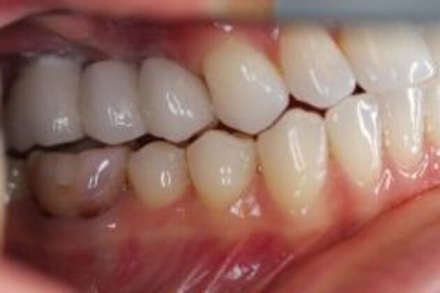 Dental Implants Case 3 - After