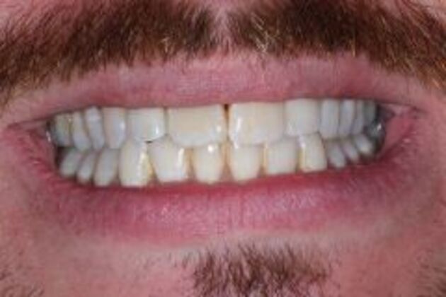 Dental Implants Case 4 - After