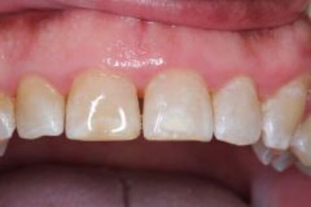 Dental Bonding Cases