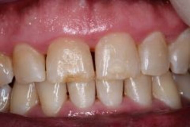 Dental Bonding Case 1 - Before