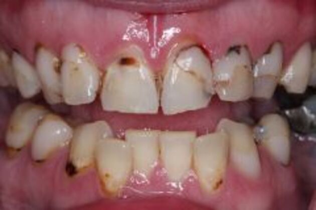 Dental Bonding Case 2 - Before