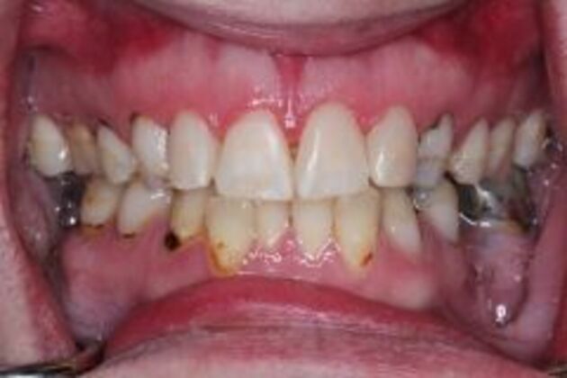Dental Bonding Case 2 - After