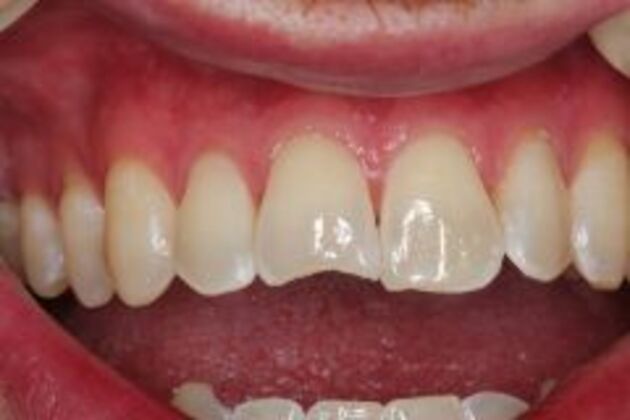Dental Bonding Case 3 - Before