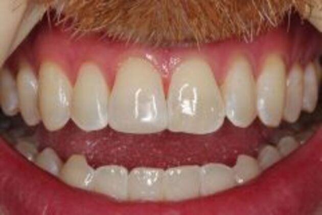 Dental Bonding Case 3 - After