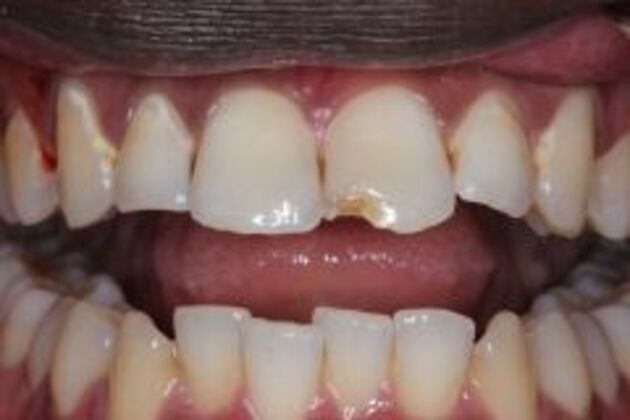 Dental Bonding Case 4 - Before