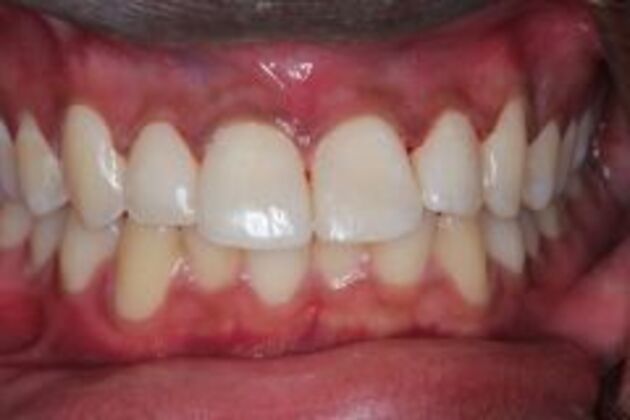 Dental Bonding Case 4 - After