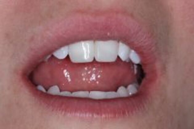 Dental Bonding Case 5 - After