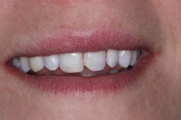 Dental Bonding Case 5 - Before
