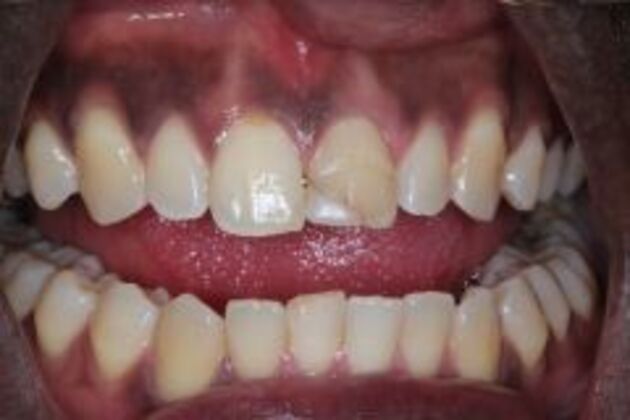 Dental Bonding Case 6 - Before