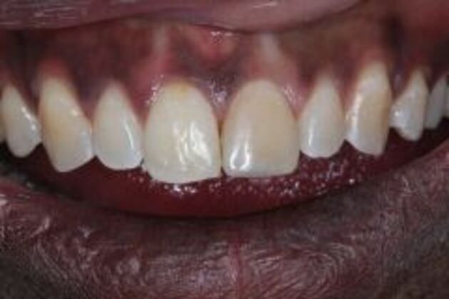Dental Bonding Case 6 - After