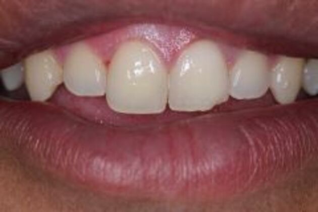 Dental Bonding Case 7 - Before