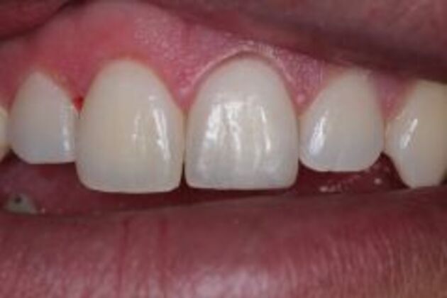 Dental Bonding Case 7 - After