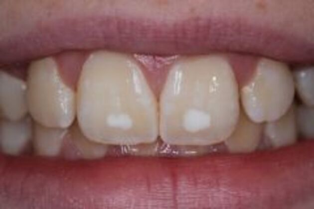 White Spot Removal Case 1 - Before