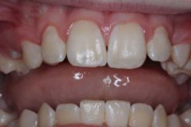 White Spot Removal Case