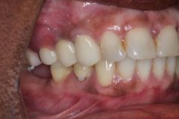 Dentures Case 1 - Before