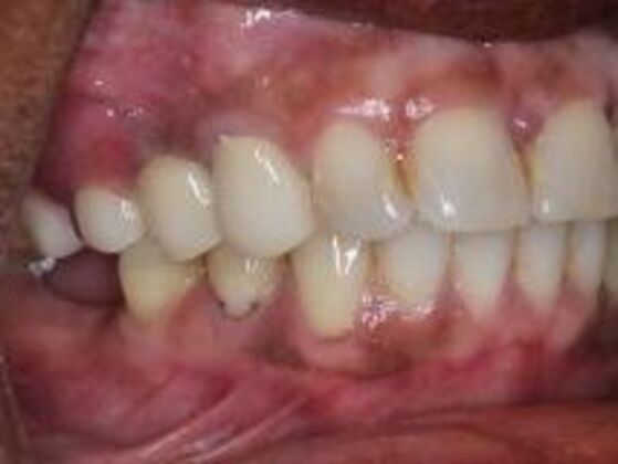 Dentures: Case 1 - Before