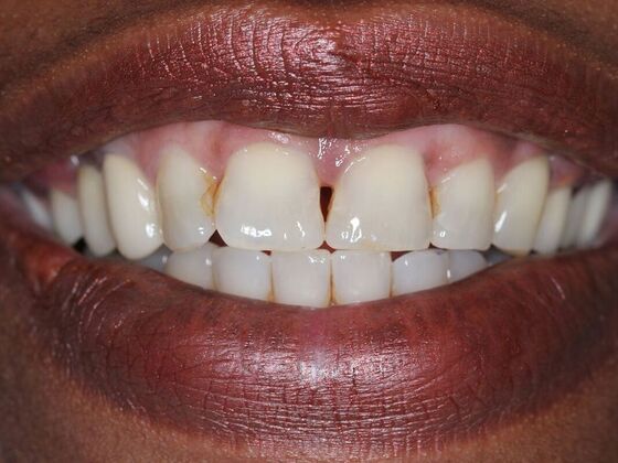 Dentures: Case 1 - After