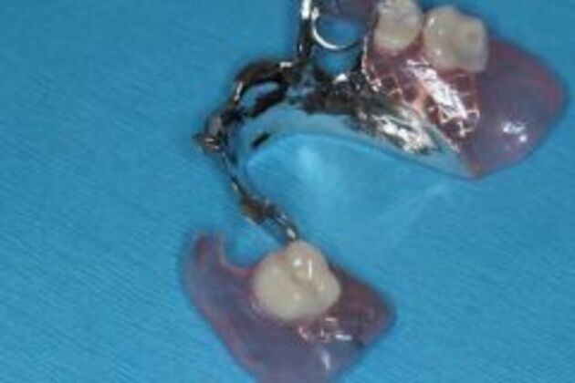 Dentures: Case 1 - Before