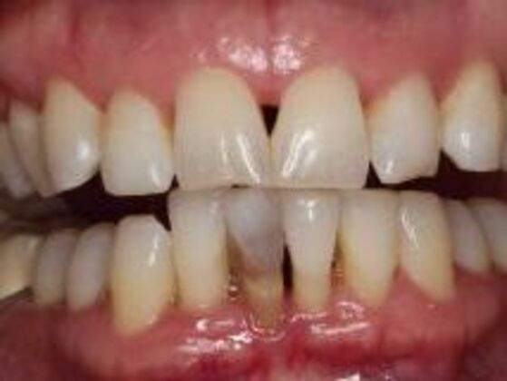 Dentures: Case 2 - Before